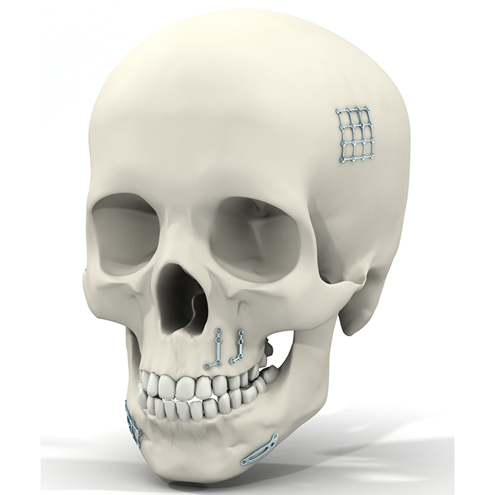 Mini – Traumatologie – Orthognatique – Reconstruction légère – Lefort – Génioplastie - cranio-maxillo-faciale