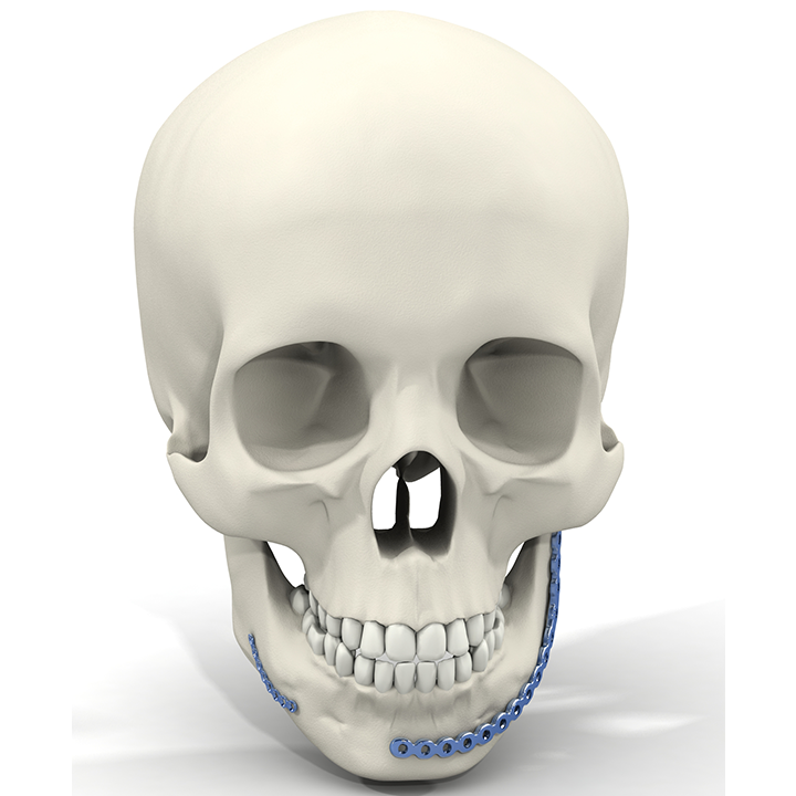 Maxi – Traumatologie mandibulaire – Reconstruction mandibulaire partielle ou totale – Cancérologie - cranio-maxillo-faciale