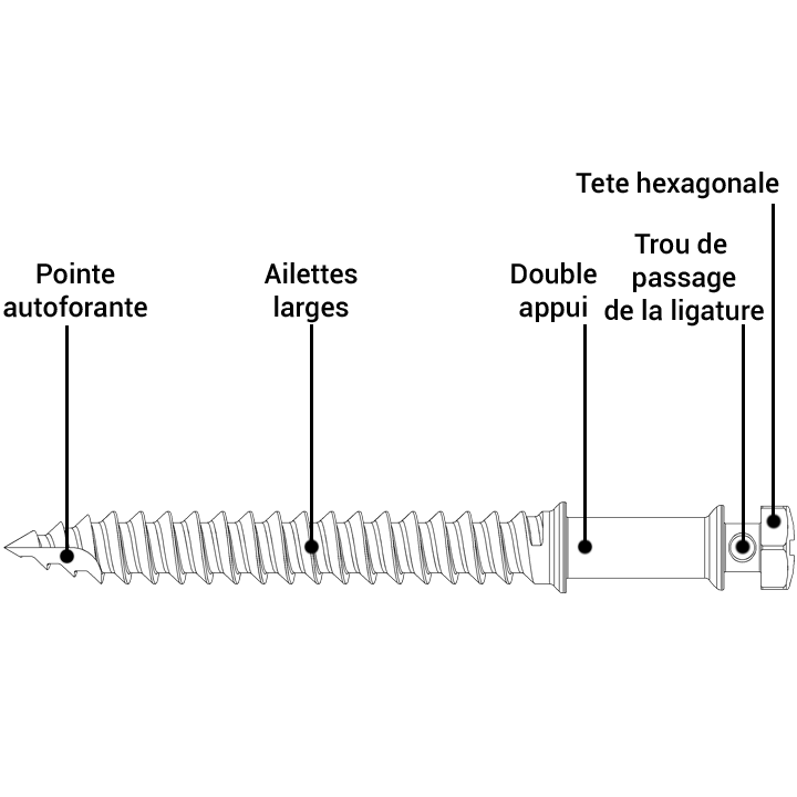 Minivis d’ancrage orthodontique DX-OMIA System